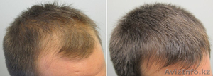 Средство от выпадения волос миноксидил 5% - Изображение #2, Объявление #1576194